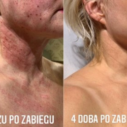RF INFINI ujędrnianie wiotkiej skóry - Klinika dr Parda Piaseczno