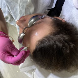 Rysowanie na twarzy pacjenta punktów wprowadzenia toksyny botulinowej - Klinika Medycyny Estetycznej Dr Parda