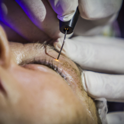 Zabieg podnoszenia górnej powieki z wykorzystaniem urządzenia PLASMAGE - Klinika Medycyny Estetycznej Dr Parda